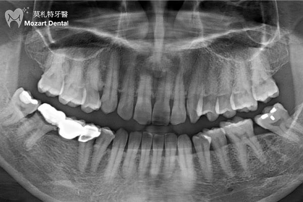 板橋牙齒矯正推薦戽斗合併缺牙before