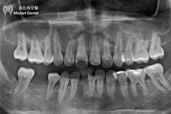 板橋牙齒矯正推薦關閉部分空間before