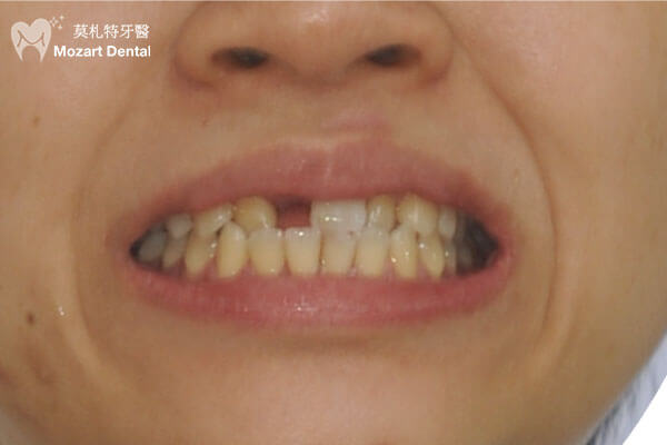 板橋牙齒矯正推薦摔斷門牙before