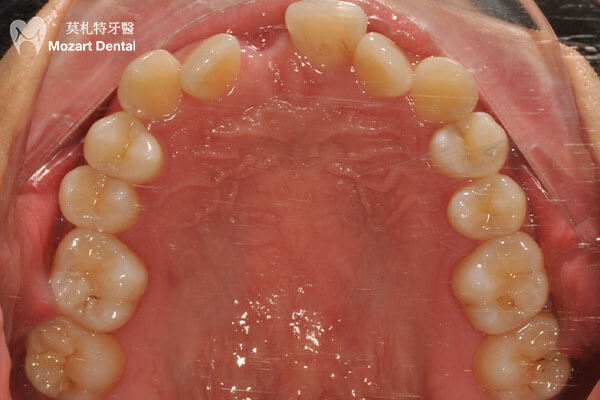 板橋牙齒矯正推薦摔斷門牙before