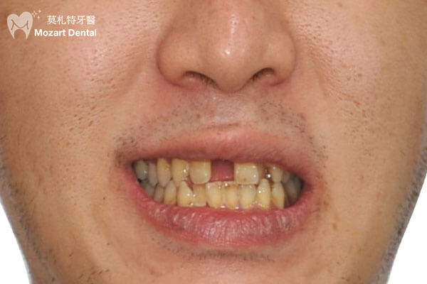 板橋牙齒矯正推薦摔斷門牙before