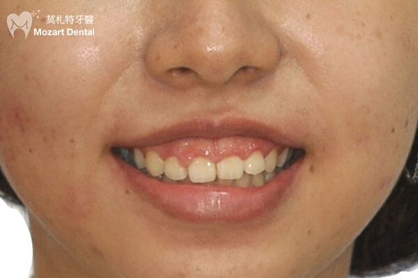板橋牙齒矯正推薦嚴重笑露牙肉before