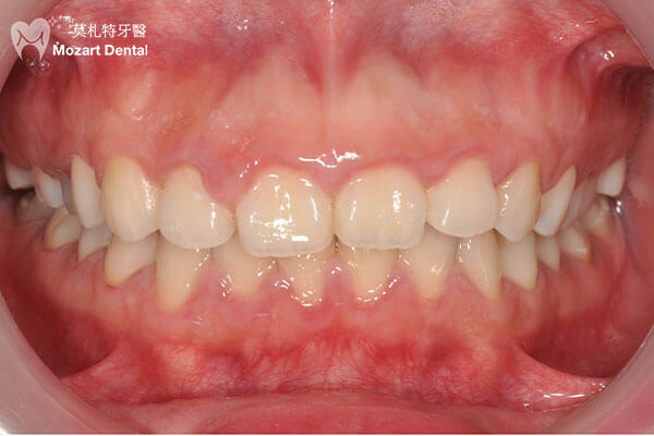 板橋牙齒矯正推薦嚴重笑露牙肉before