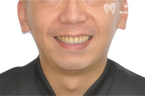 板橋牙齒矯正推薦開咬after