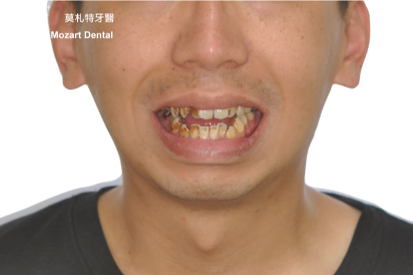 板橋牙齒矯正推薦開咬before