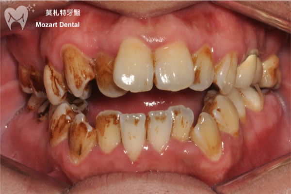 板橋牙齒矯正推薦開咬before