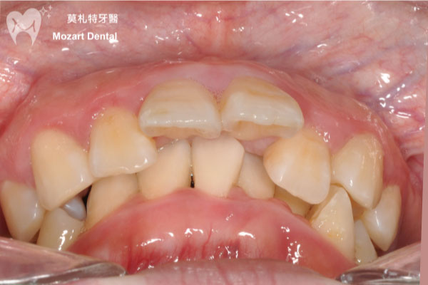 板橋牙齒矯正推薦深咬合before
