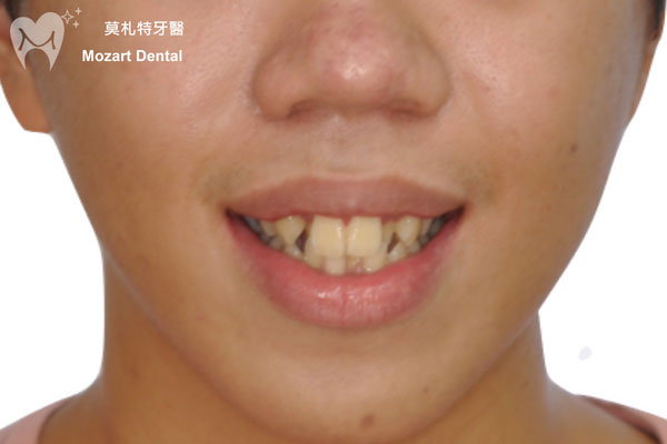 板橋牙齒矯正推薦牙亂before