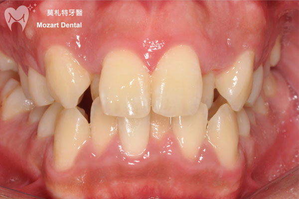 板橋牙齒矯正推薦牙亂before