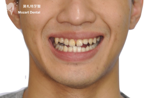 板橋牙齒矯正推薦戽斗before