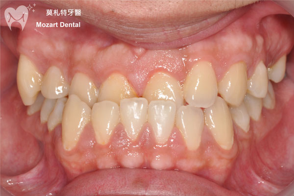 板橋牙齒矯正推薦戽斗before