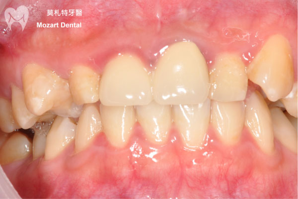 板橋牙齒矯正推薦阻生齒before