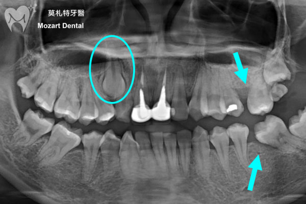 板橋牙齒矯正推薦阻生齒before