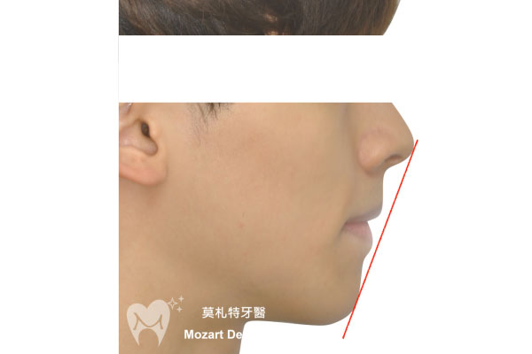 板橋牙齒矯正推薦嘴突唇形改正after