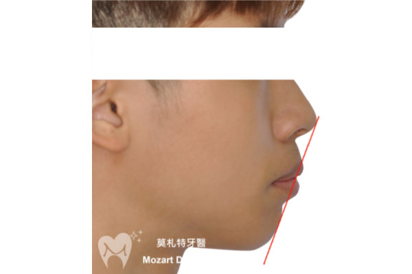 板橋牙齒矯正推薦嘴突唇形改正before
