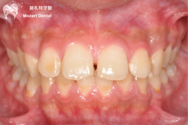 板橋牙齒矯正推薦嘴突唇形改正before