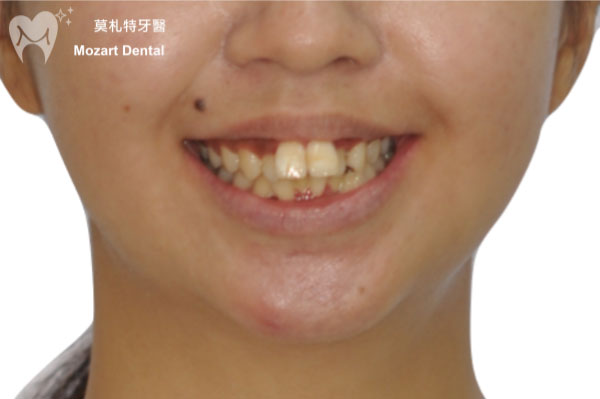 板橋牙齒矯正推薦兔寶寶門牙before