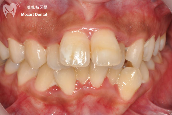 板橋牙齒矯正推薦兔寶寶門牙before