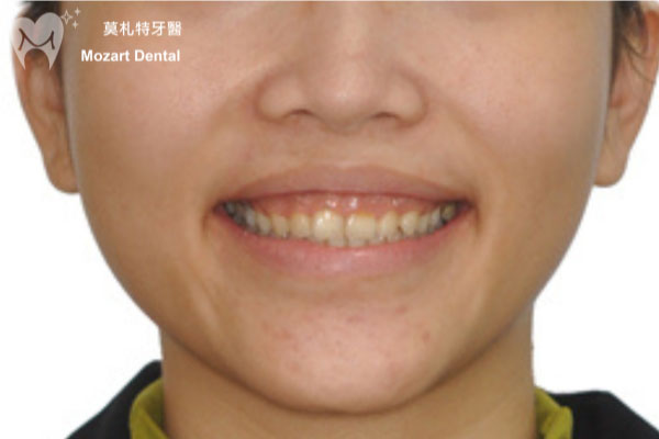 板橋牙齒矯正推薦笑牙齦before